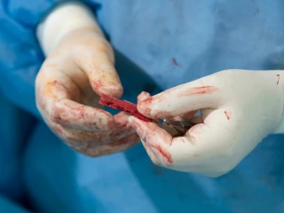 autologní transplantace