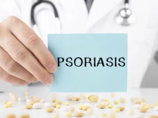 psoriasis ruka a leky