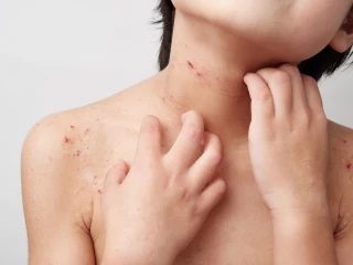 kůže atopic dítě dermatitida ekzém
