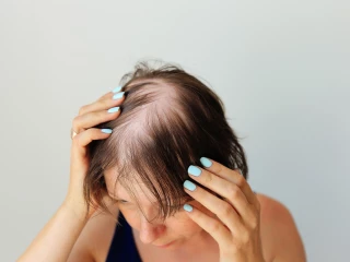 Alopecia