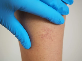 Thrombotic Thrombocytopenic Purpura