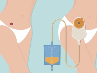UROSTOMY