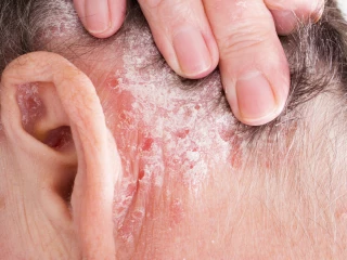 plakova psoriaza