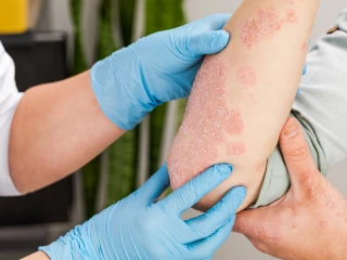 Psoriaza_loket_pacient_lékař