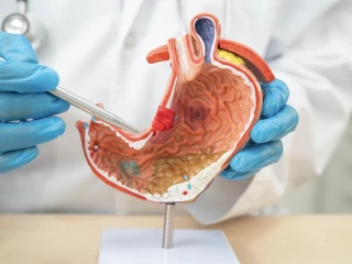 31dyspepsia