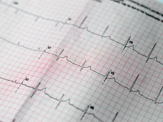 left ventricular hypertrophy