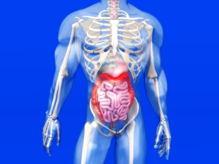 ulcerative colitis