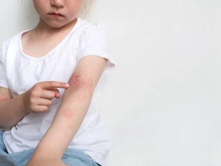 atopická dermatitida_dítě