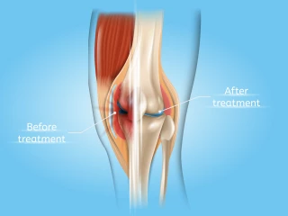 Treatment of Knee Pain and Arthritis