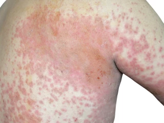 atopická dermatitida detail kůže