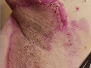 hidradenitis suppurativa