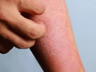 atopická dermatitida na ruce