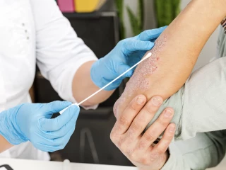 psoriaszis