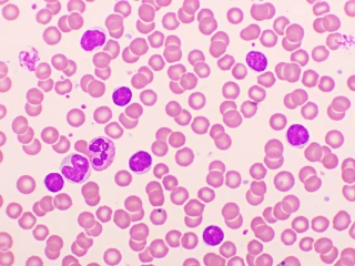 Venetoklax v léčbě relabující/refrakterní CLL – data z reálné klinické praxe