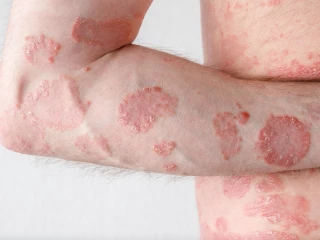 psoriaza