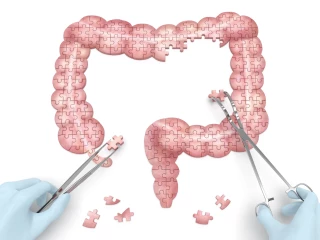 ulcerative colitis v