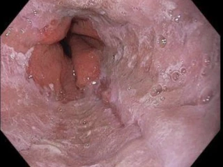 Bolest v krku jako projev gastroezofageálního refluxu – kazuistika obr 1