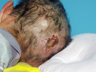 decubitus