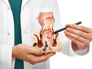 rectal cancer