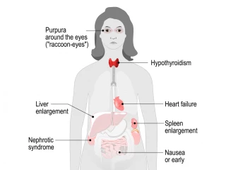amyloidóza symptomy