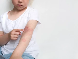 dívka s atopickou dermatitidou na rukou