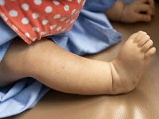 thrombocytopaenia