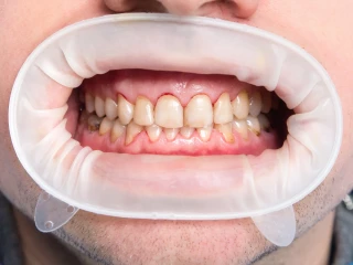 Hypomineralizace molárů a řezáků