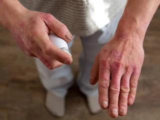 Pěna ve spreji pro léčbu psoriázy