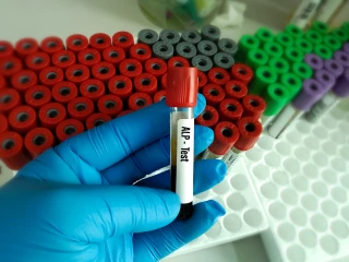 Laboratoř_měření_jaterní_hodnoty_ALP_test