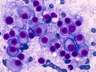 Mnohočetný myelom_vícenásobný_myelom_cytologie