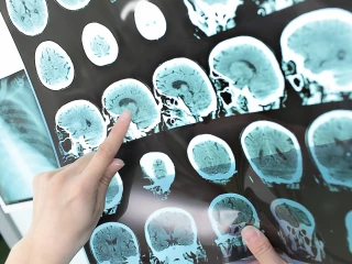 roztroušená skleróza mozek mri vyšetření snímek