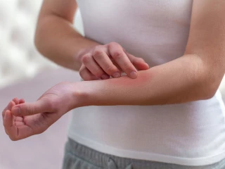 skrabani_pruritus_ekzem_svedeni_kozni_reakce_podrazdena_pokozka