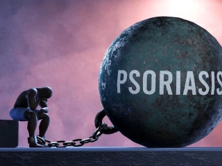 Psoriáza