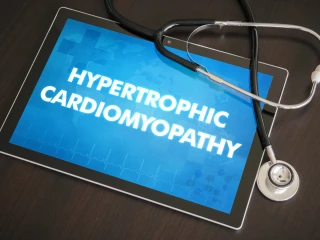 hypertrofická kardiomyopatie