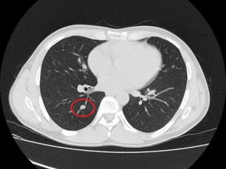 Vemurafenib_1