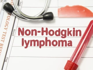 Hodgkinovu lymfomu