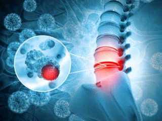 Spine cancer