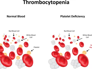Trombocytopenie