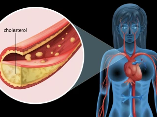 hypercholesterol