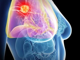 grafika_ilustrace_tumor_prso_rakovina_prsu