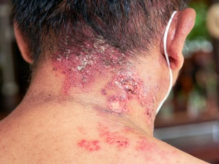 INFECTION ON THE BODY