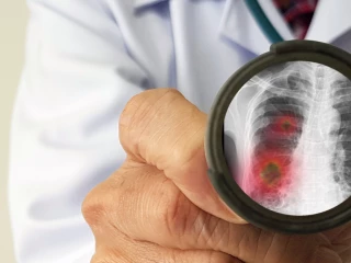 pneumonie
