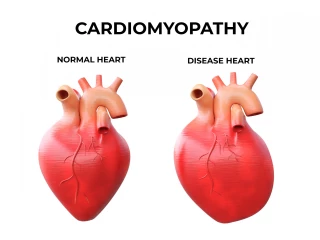 kardiomyopatie 2