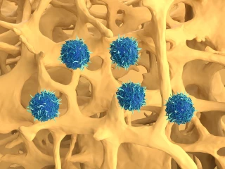 CAR T cell terapie Osteporozy