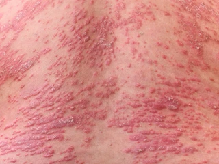 tezka psoriaza