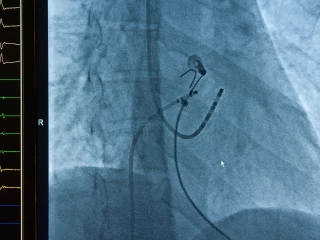 fibrilace_sini_zaneseni_katetru_kardiologie