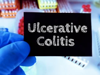 ulcerative colitis33