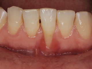 gingivitidou