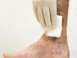 leg ulcers