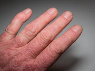 Ruka a prsty s psoriázou u psoriatické artrititidy